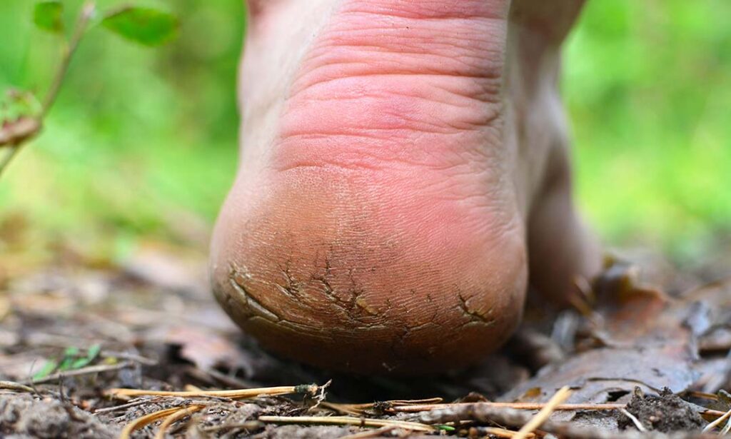 Fuß mit dicker Hornhaut - Eine Ursache für Blasenbildung durch Scherkräfte