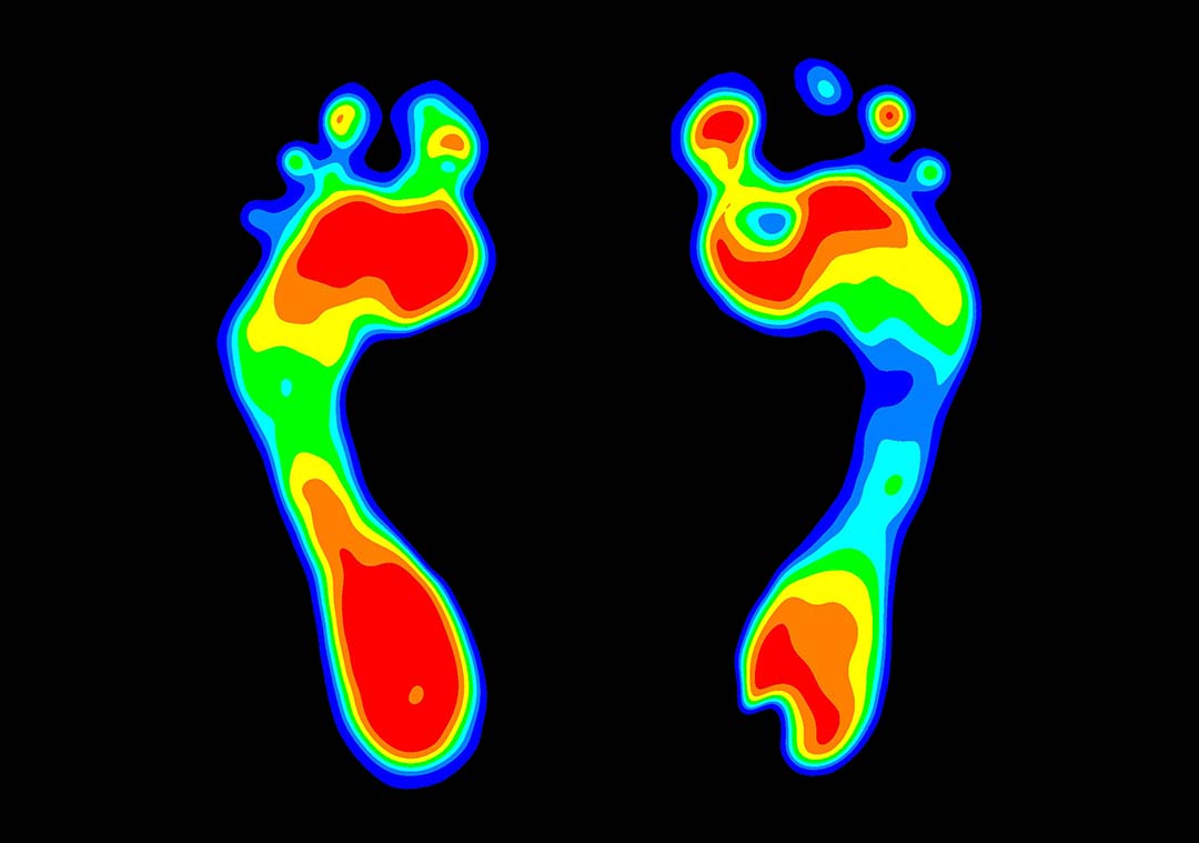 Hoher Druck im Vorfuß- und Fersenbereich am Fuß